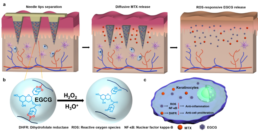 华中科技大学刘奕静、朱锦涛 ACS Nano：ROS响应微针用于银屑病治疗,图片,ROS响应,微针,银屑病,抑制,角质细胞,第1张