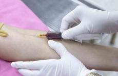 有更好的方法诊断镰状细胞贫血吗色谱法探索